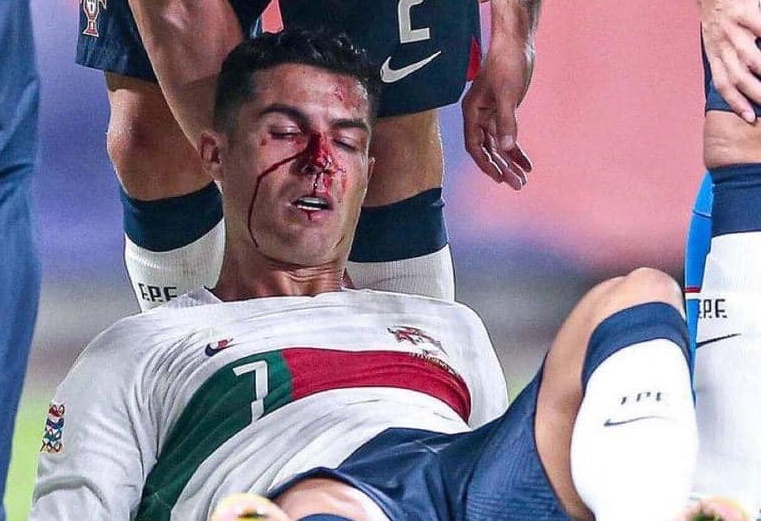 Ronaldo đổ máu đầm đìa trong trận đấu của Bồ Đào Nha